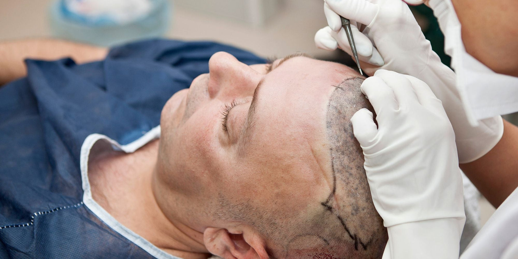 soorten haartransplantatie