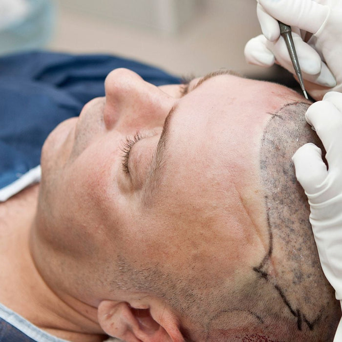 soorten haartransplantatie